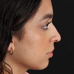 Rhinoplasty Before & After Patient #3269