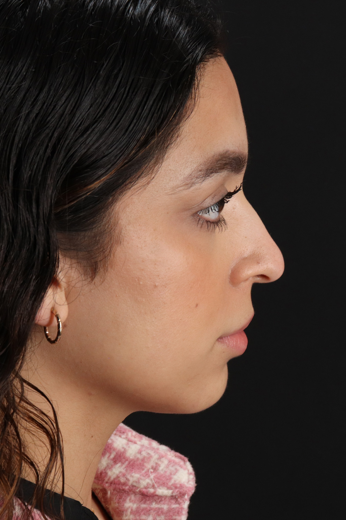 Rhinoplasty Before & After Patient #3269