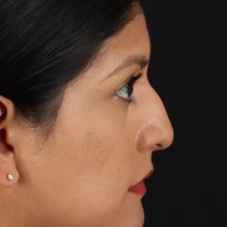 Rhinoplasty Before & After Patient #3181
