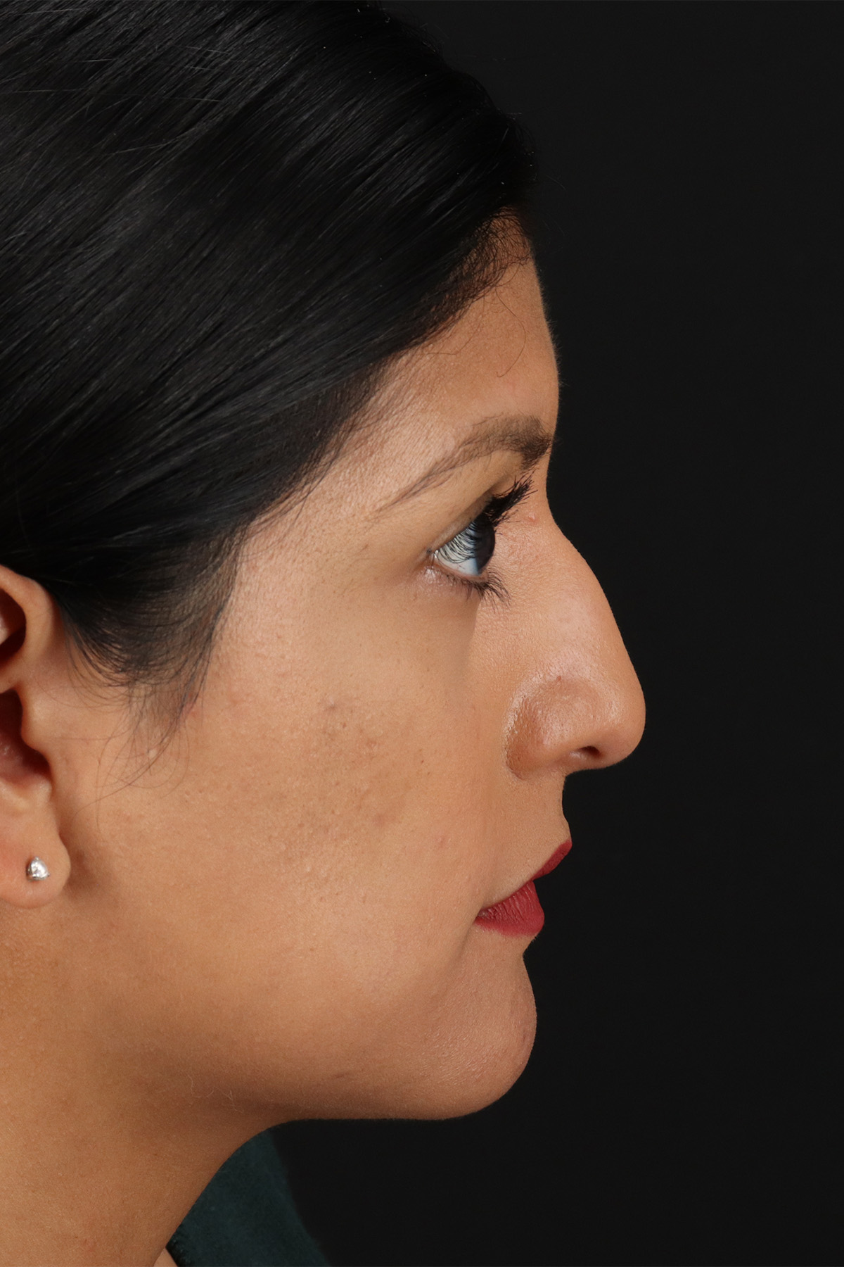 Rhinoplasty Before & After Patient #3181