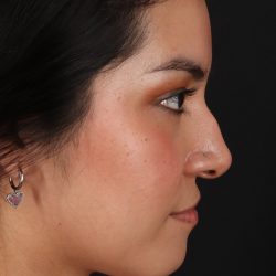 Fillers Before & After Patient #2041