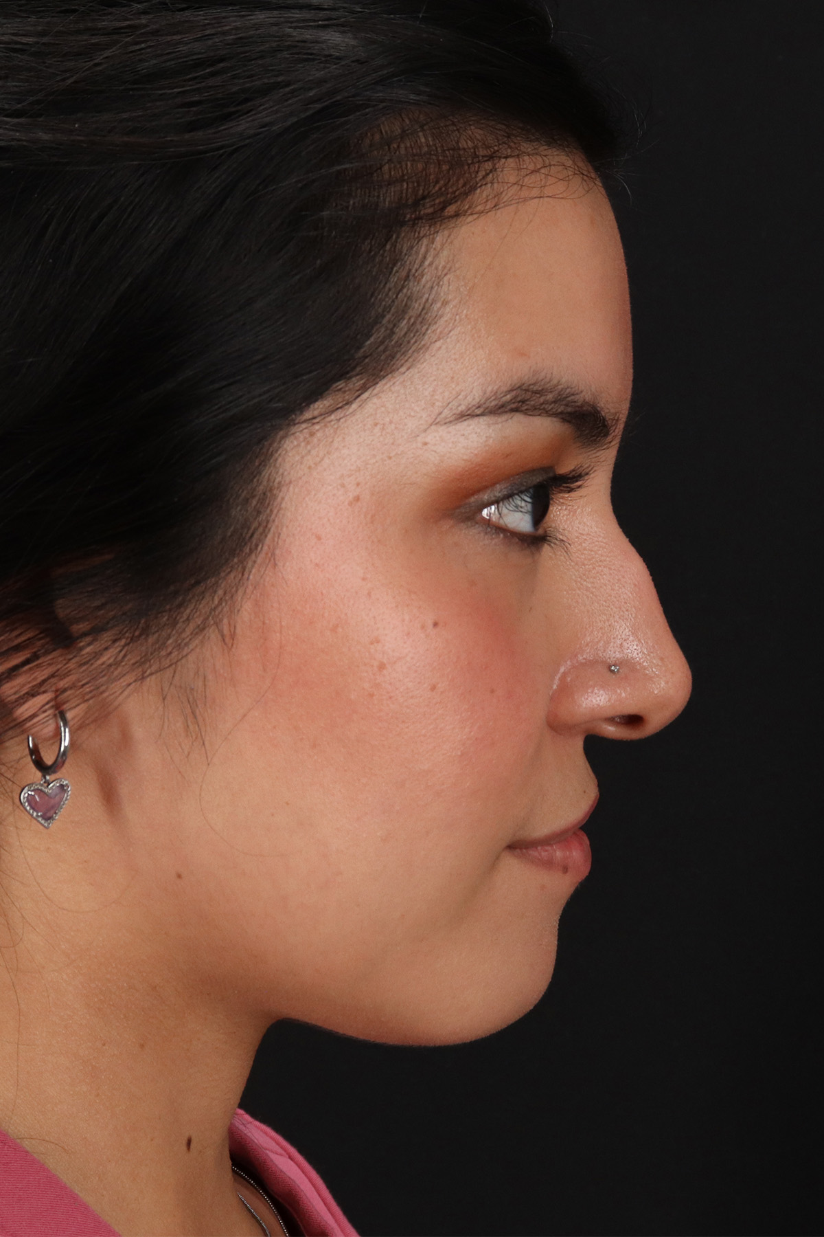 Liquid Rhinoplasty Before & After Patient #2265