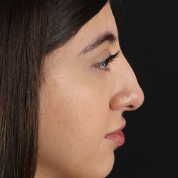 Rhinoplasty Before & After Patient #3214