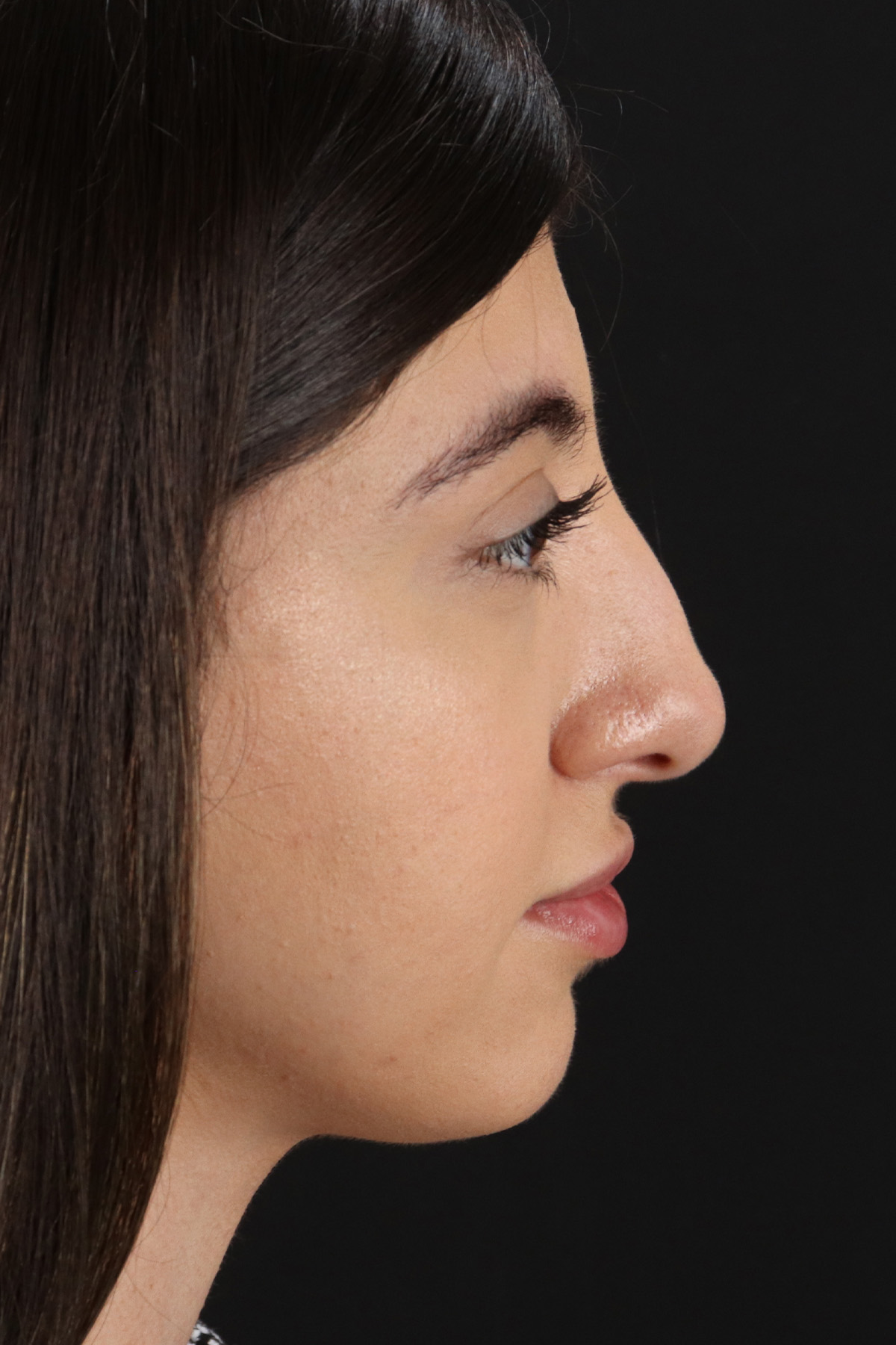 Rhinoplasty Before & After Patient #3214
