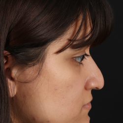 Rhinoplasty Before & After Patient #3038