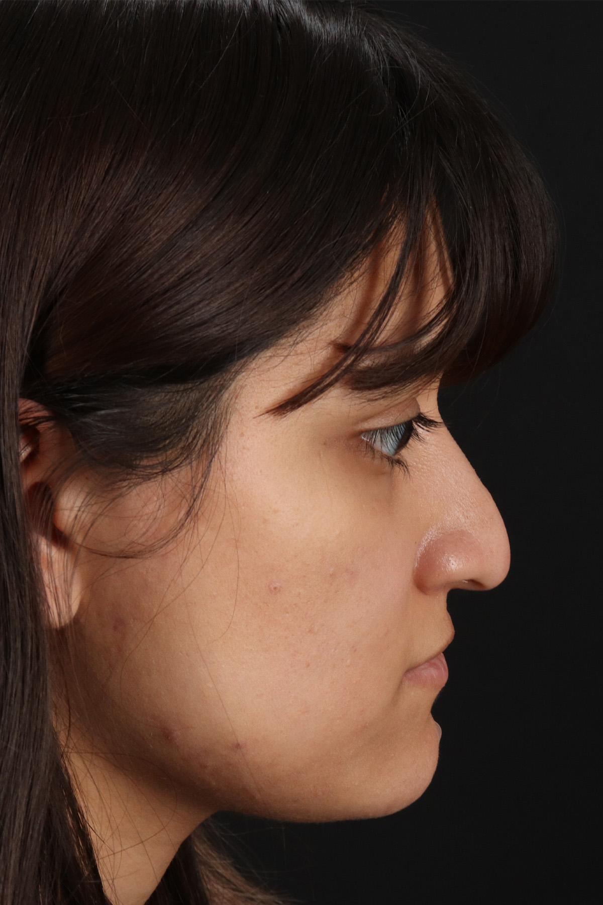 Rhinoplasty Before & After Patient #3038