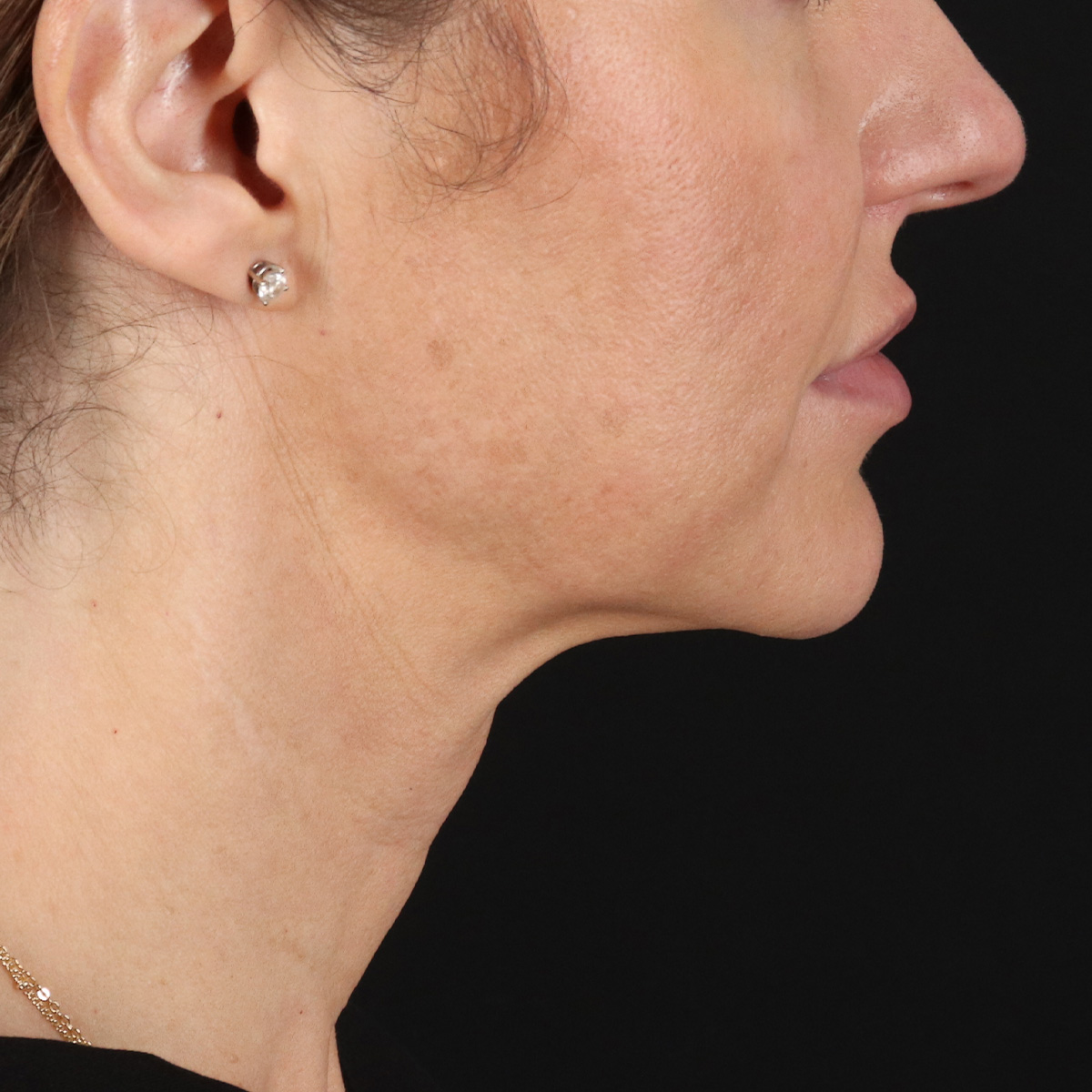 Facelift Before & After Patient #1921