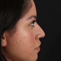 Fillers Before & After Patient #2063