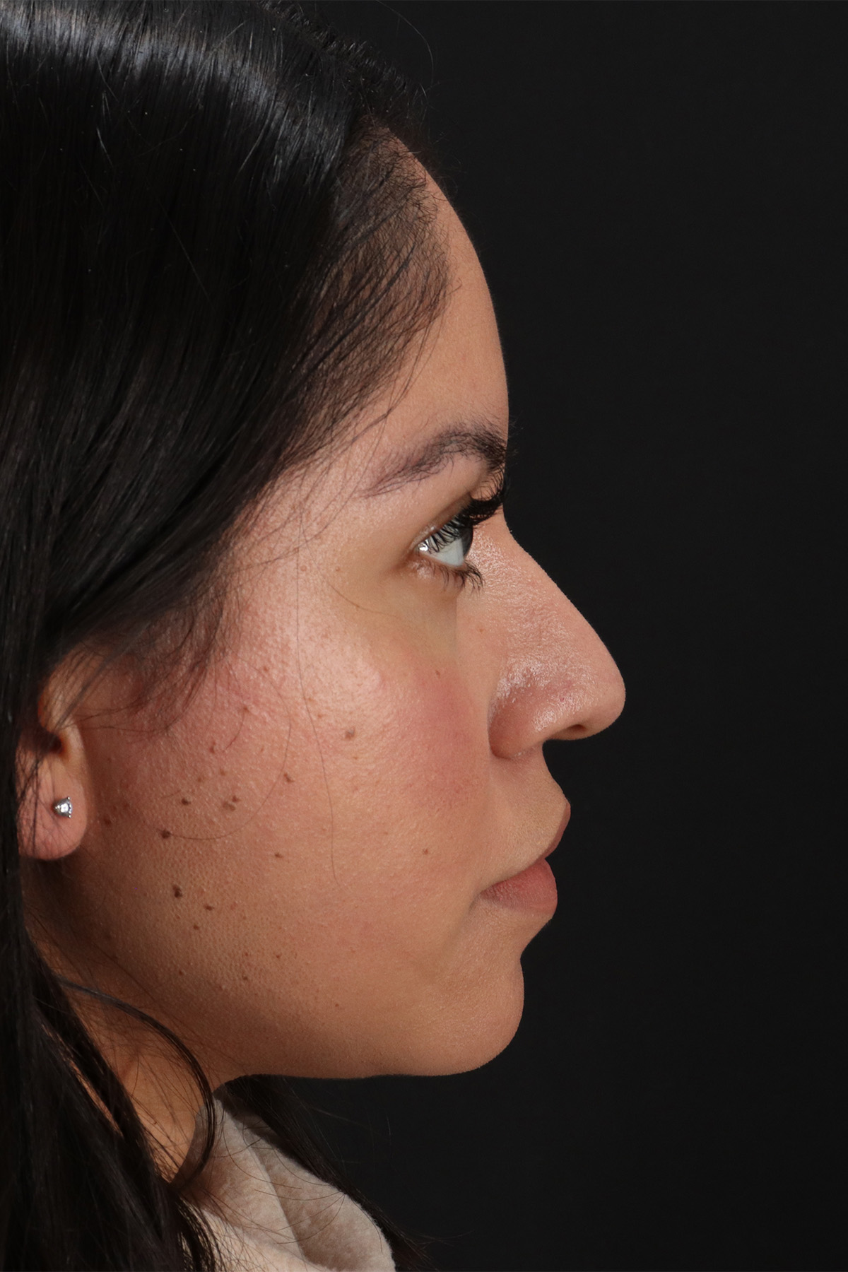 Fillers Before & After Patient #2063