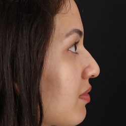 Rhinoplasty Before & After Patient #3236