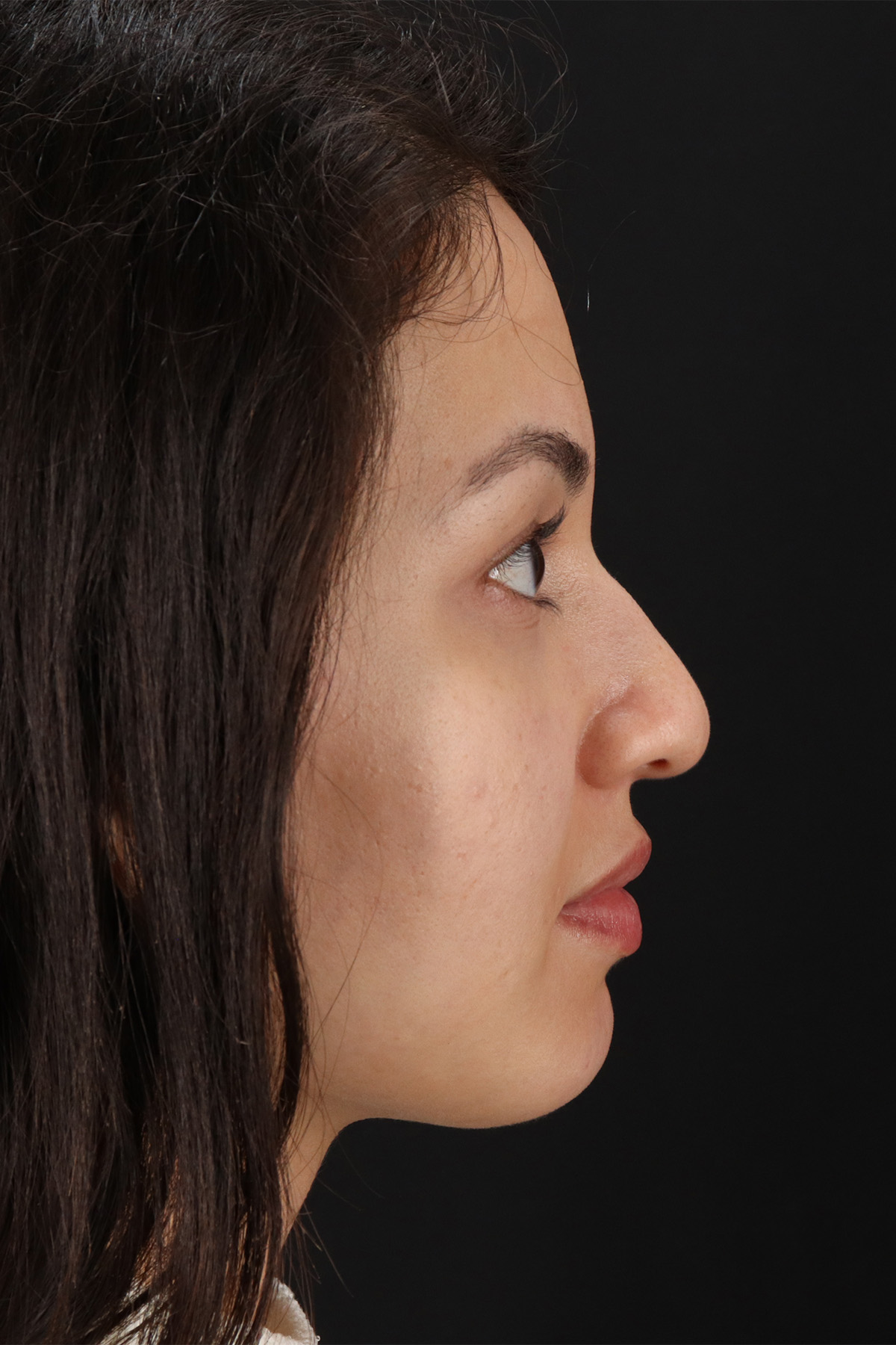 Rhinoplasty Before & After Patient #3236
