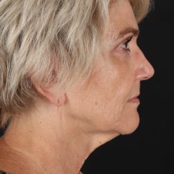 Neck Lift Before & After Patient #2648