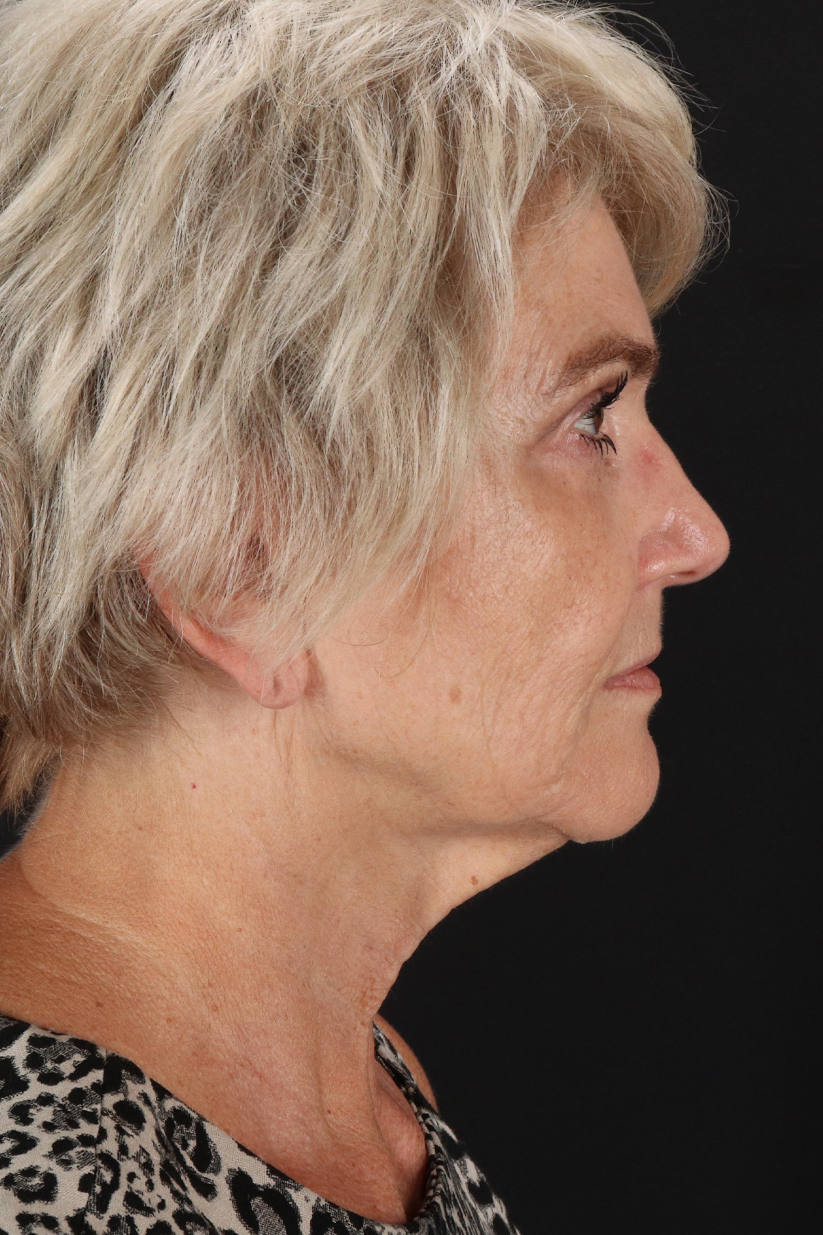 Neck Lift Before & After Patient #2648