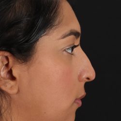 Liquid Rhinoplasty Before & After Patient #2232