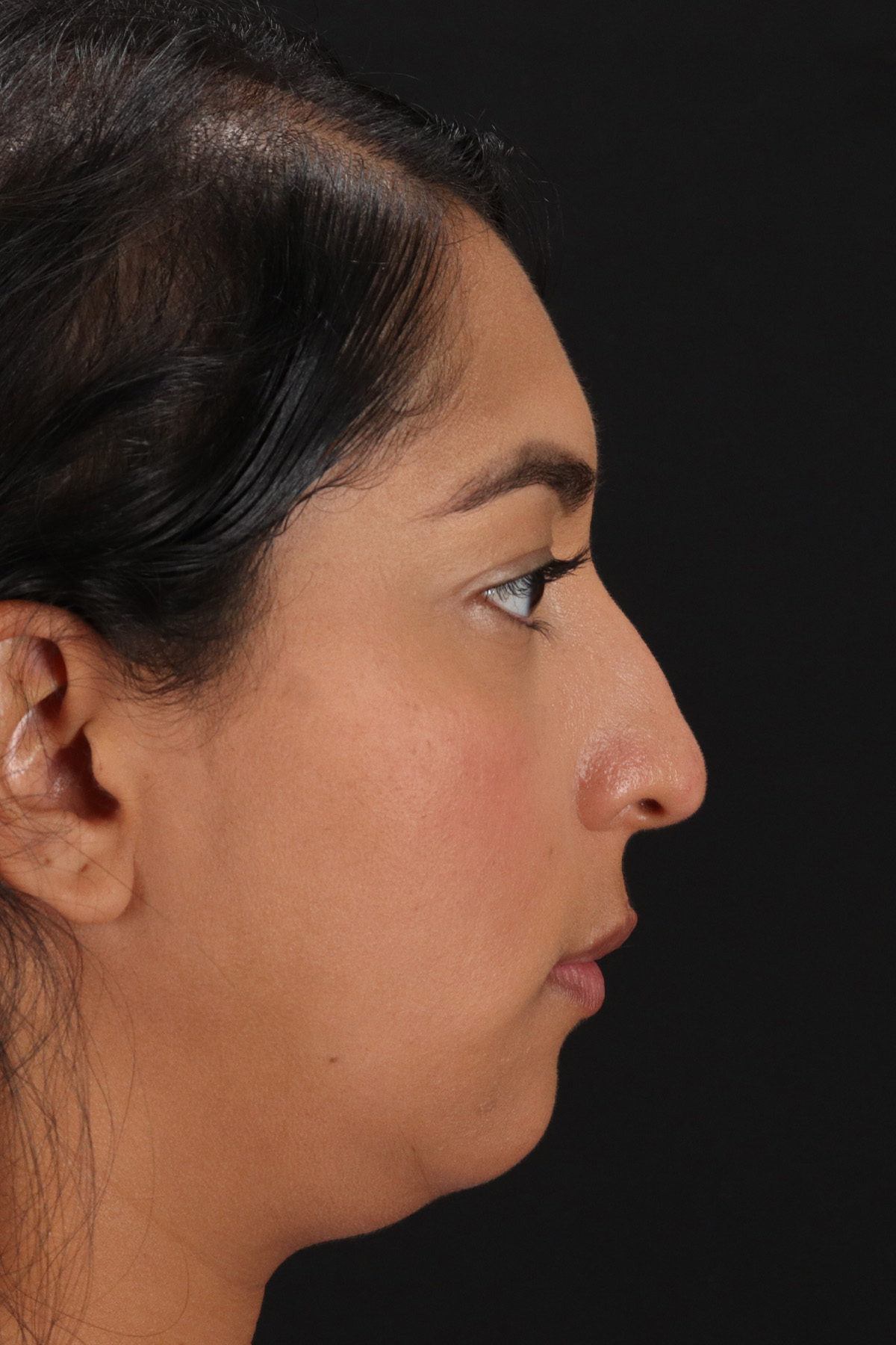 Liquid Rhinoplasty Before & After Patient #2232