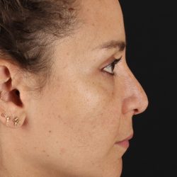 Liquid Rhinoplasty Before & After Patient #2276