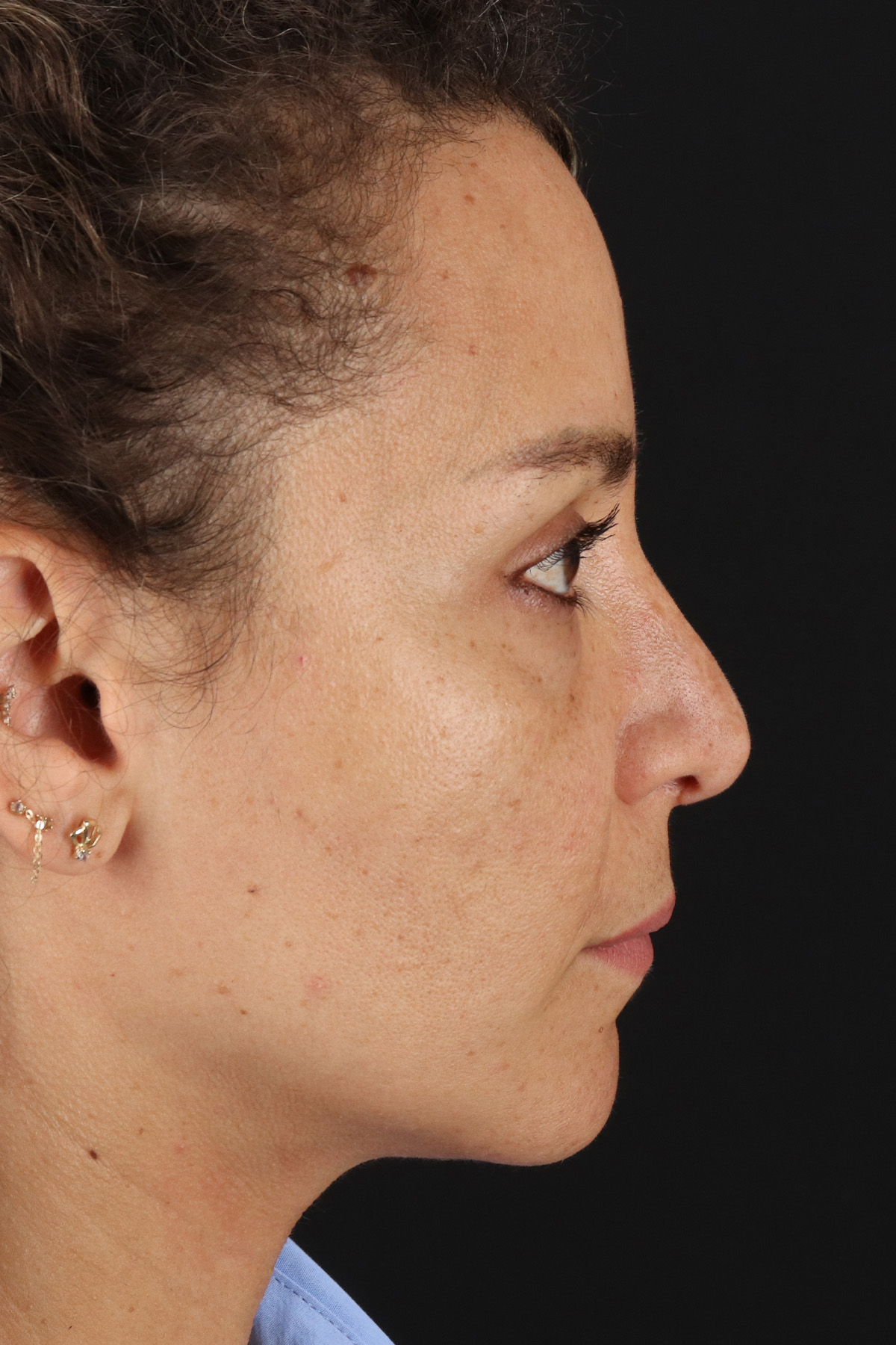 Liquid Rhinoplasty Before & After Patient #2276