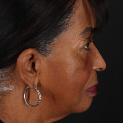 Neck Lift Before & After Patient #2615