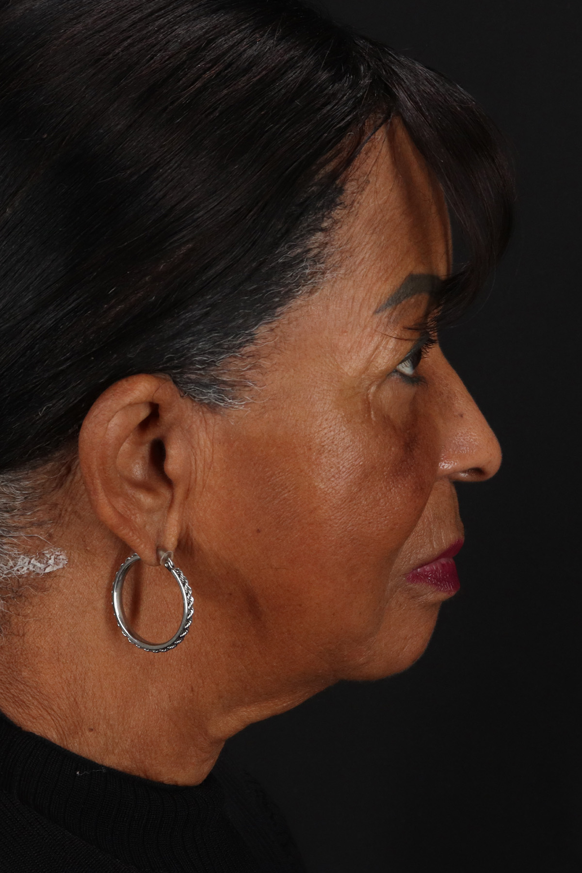 Chin Implant Before & After Patient #1648