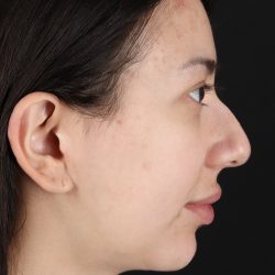 Rhinoplasty Before & After Patient #3159