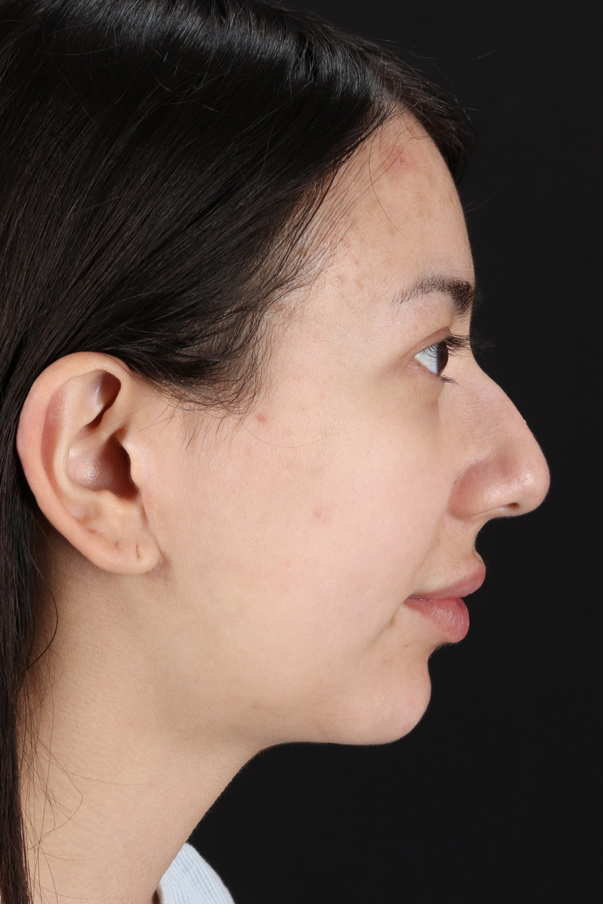 Rhinoplasty Before & After Patient #3159