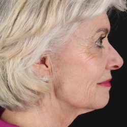 Upper Blepharoplasty Before & After Patient #5377