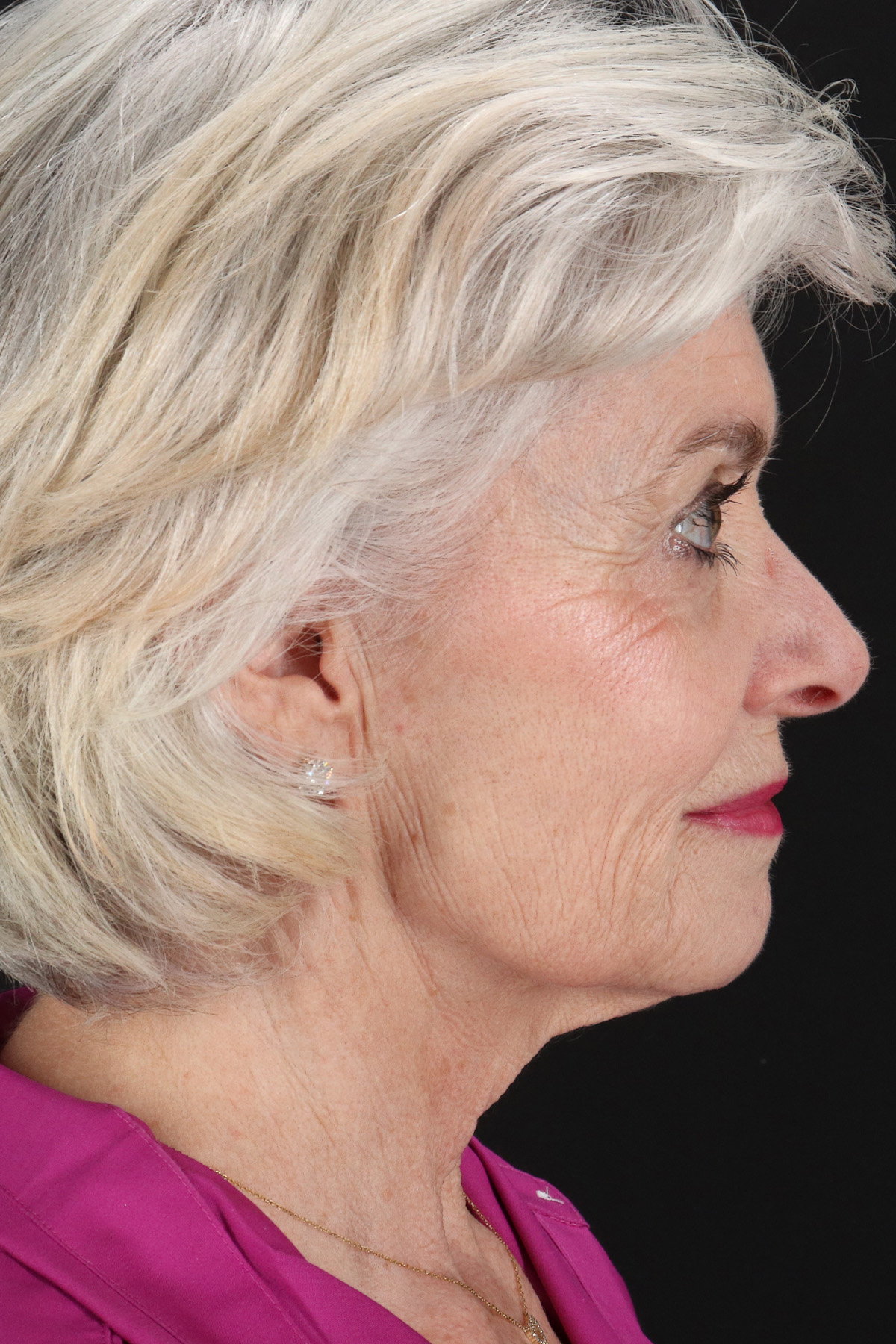 Upper Blepharoplasty Before & After Patient #5377