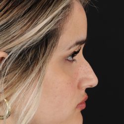 Rhinoplasty Before & After Patient #3258