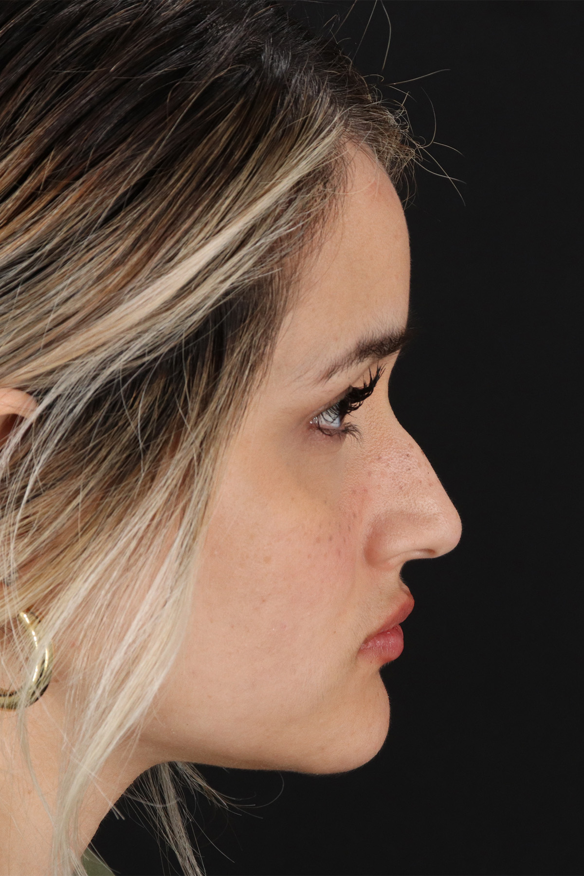 Rhinoplasty Before & After Patient #3258