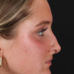 Liquid Rhinoplasty Before & After Patient #2221