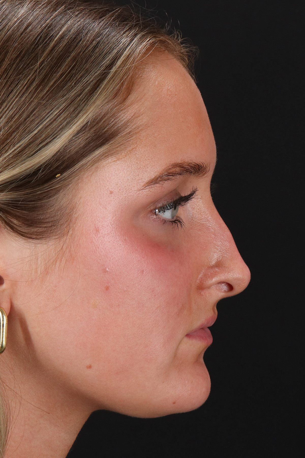 Liquid Rhinoplasty Before & After Patient #2221