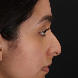 Chin Implant Before & After Patient #1637