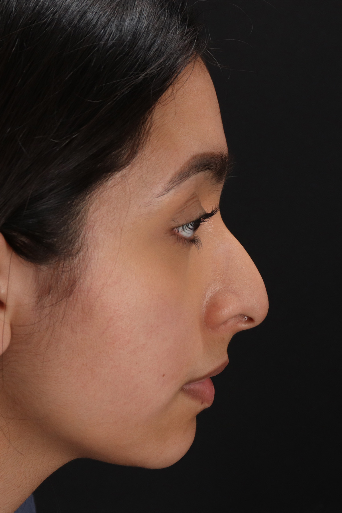 Chin Implant Before & After Patient #1637
