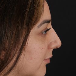 Rhinoplasty Before & After Patient #3115