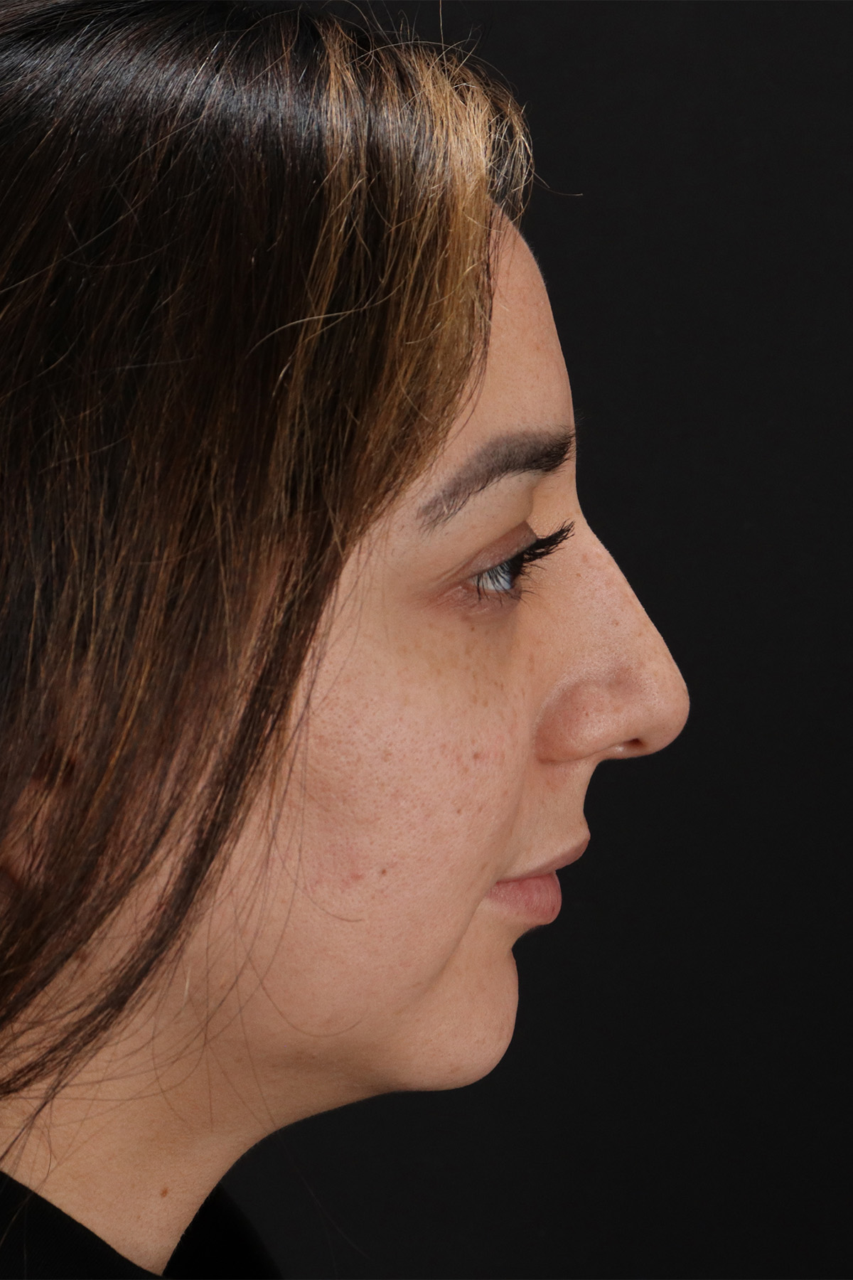 Rhinoplasty Before & After Patient #3115