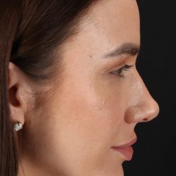 Rhinoplasty Before & After Patient #3137