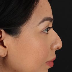 Chin Implant Before & After Patient #1626