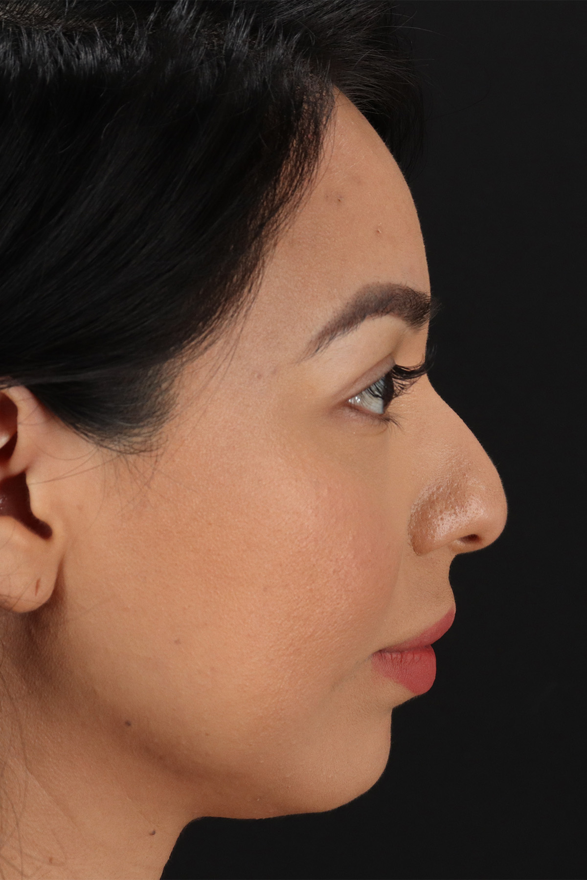 Chin Implant Before & After Patient #1626