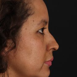 Rhinoplasty Before & After Patient #3225