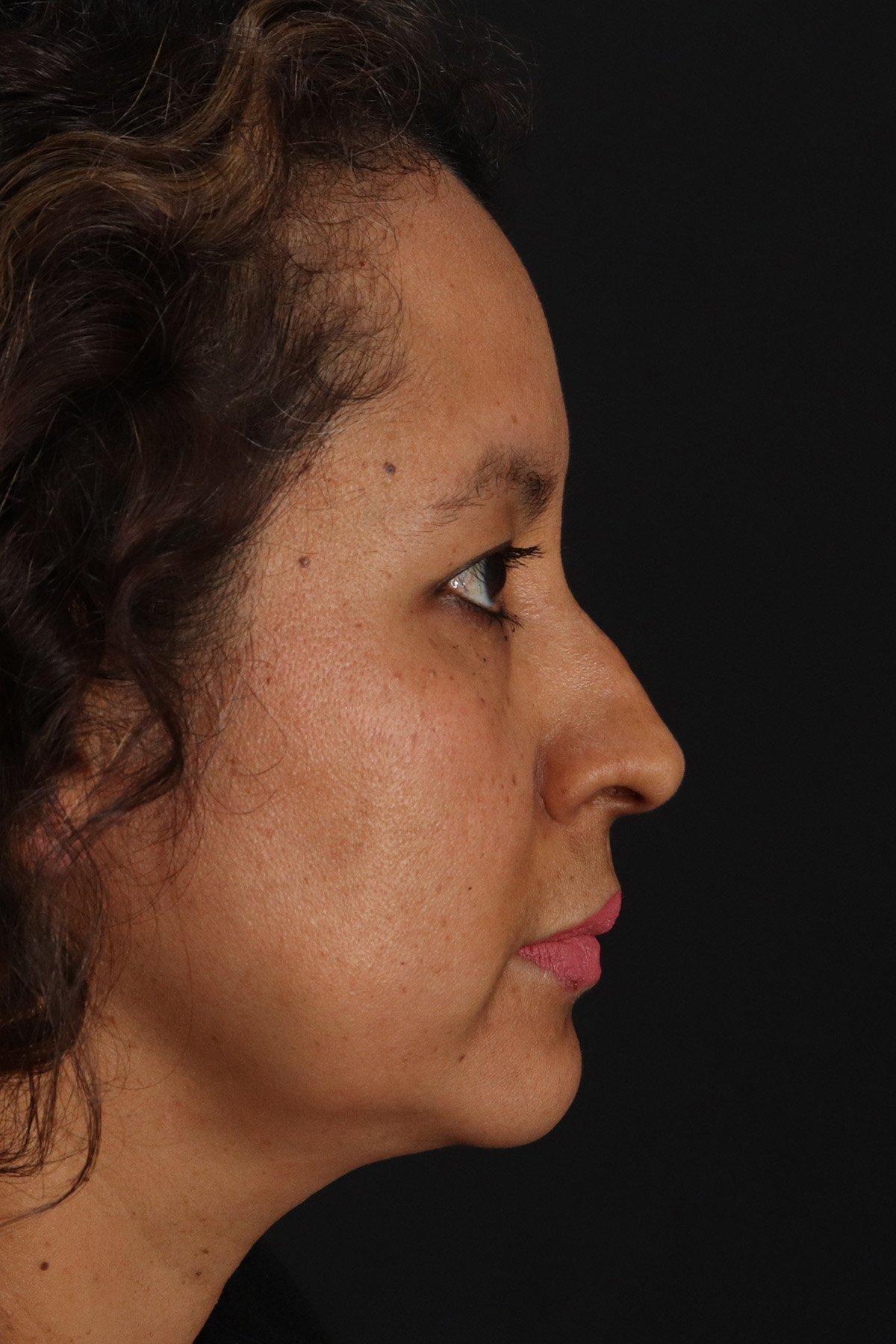 Rhinoplasty Before & After Patient #3225