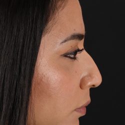Rhinoplasty Before & After Patient #3082