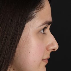 Liquid Rhinoplasty Before & After Patient #2188