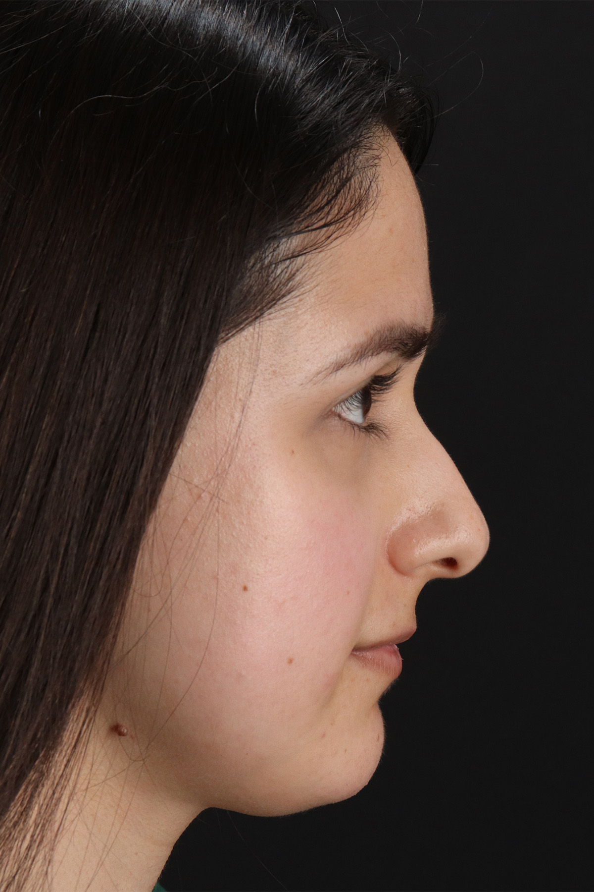 Liquid Rhinoplasty Before & After Patient #2188