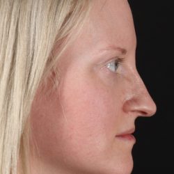 Rhinoplasty Before & After Patient #3126