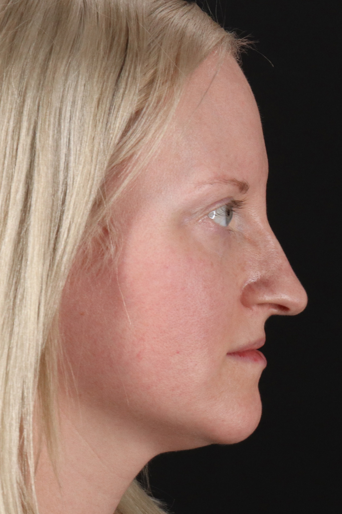 Rhinoplasty Before & After Patient #3126