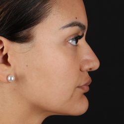 Rhinoplasty Before & After Patient #3192