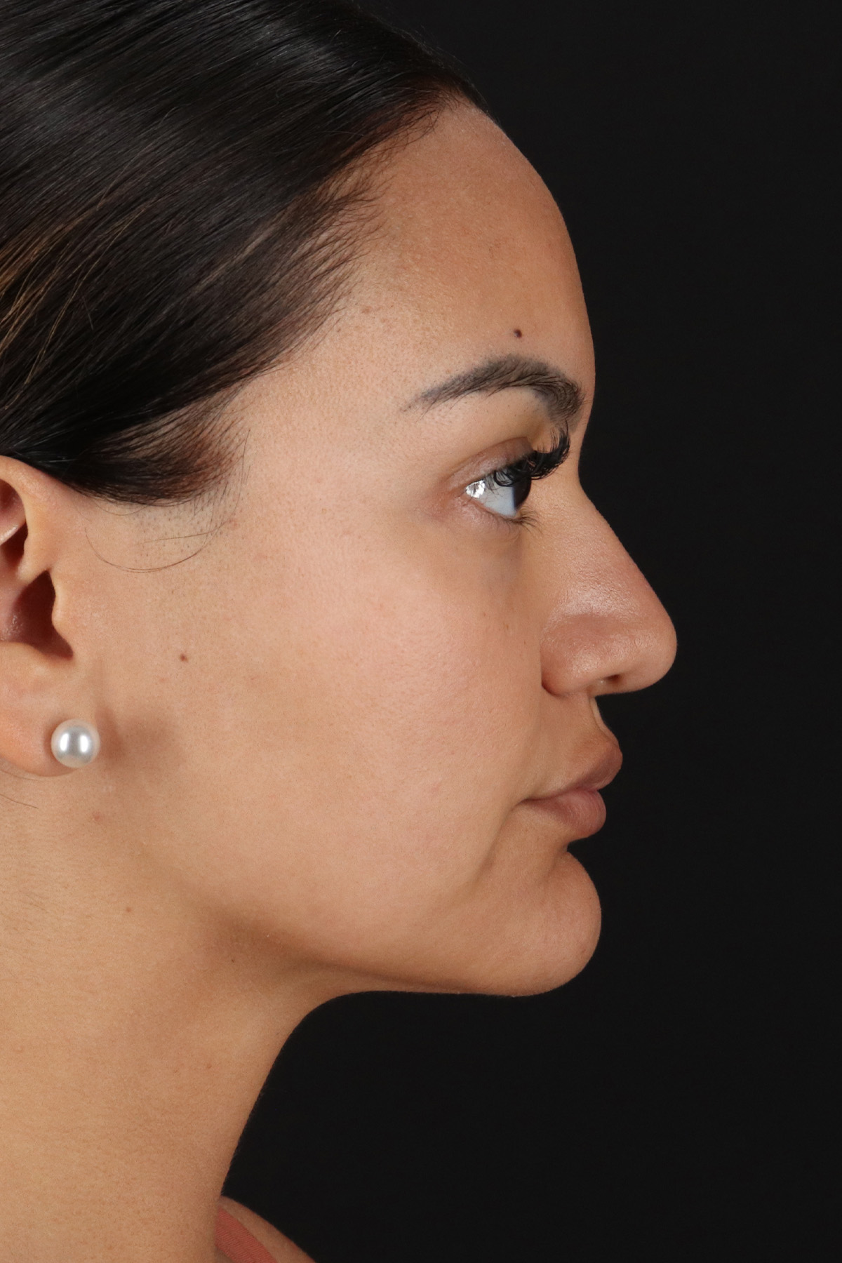 Rhinoplasty Before & After Patient #3192