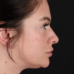 Rhinoplasty Before & After Patient #3093