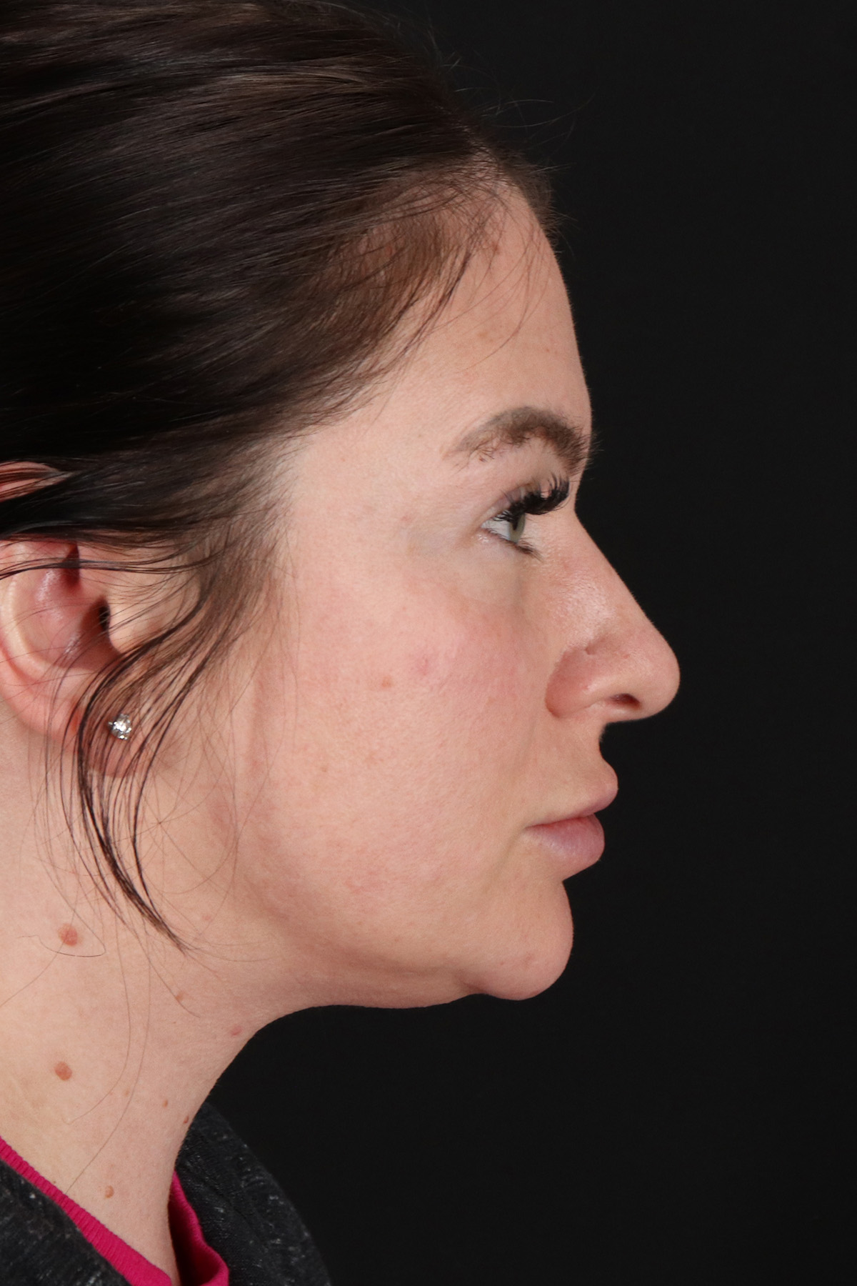 Rhinoplasty Before & After Patient #3093
