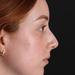 Rhinoplasty Before & After Patient #3170